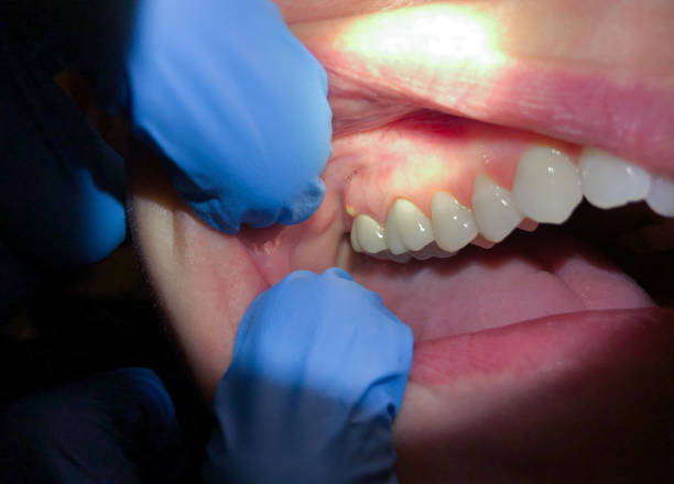 Best Emergency Treatment for Dental Infections or Abscesses in Ranger, TX